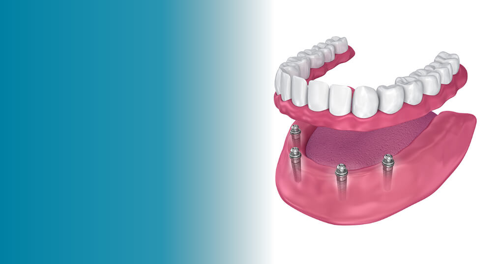 All-on-4 Dental Implants in Vista CA