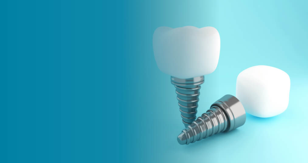 Dental Implants Vista CA